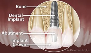 Implant Dentistry scarborough